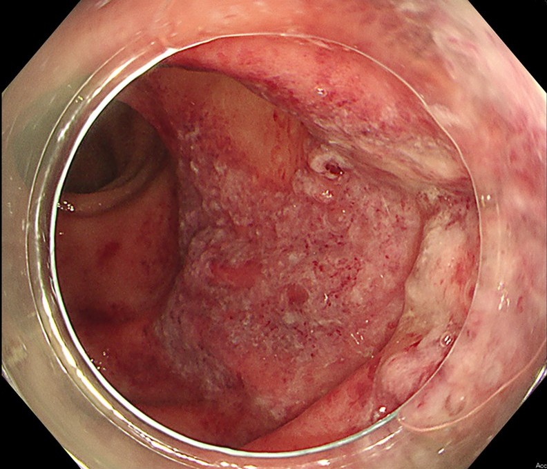 虚血性腸炎の内視鏡画像2