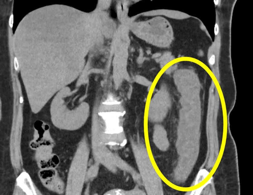 虚血性腸炎のCT画像