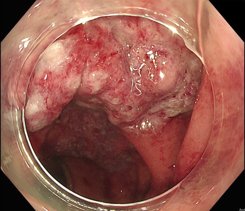 虚血性腸炎の内視鏡画像1