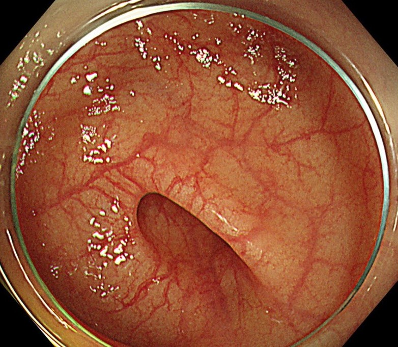 大腸憩室の図解