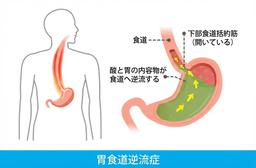 胃と食道のフタ（下部食道括約筋）の仕組み