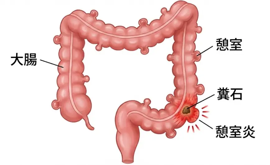 憩室炎の原因