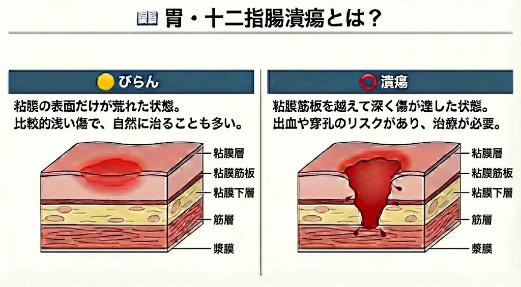 びらんと潰瘍の違い